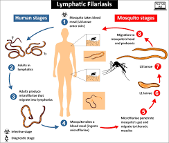 filariasis1